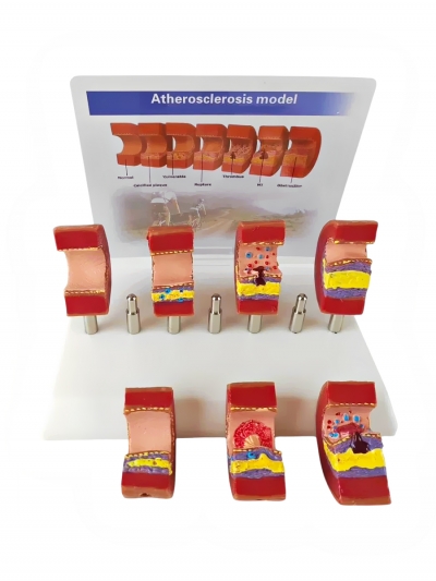 Разборная анатомическая модель атеросклероза сосуда Corpo de Atherosclerosis-3